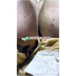 學生實際保養案例分享|青春期粉刺痘痘肌保養 學生實際保養案例分享|青春期粉刺痘痘肌保養
